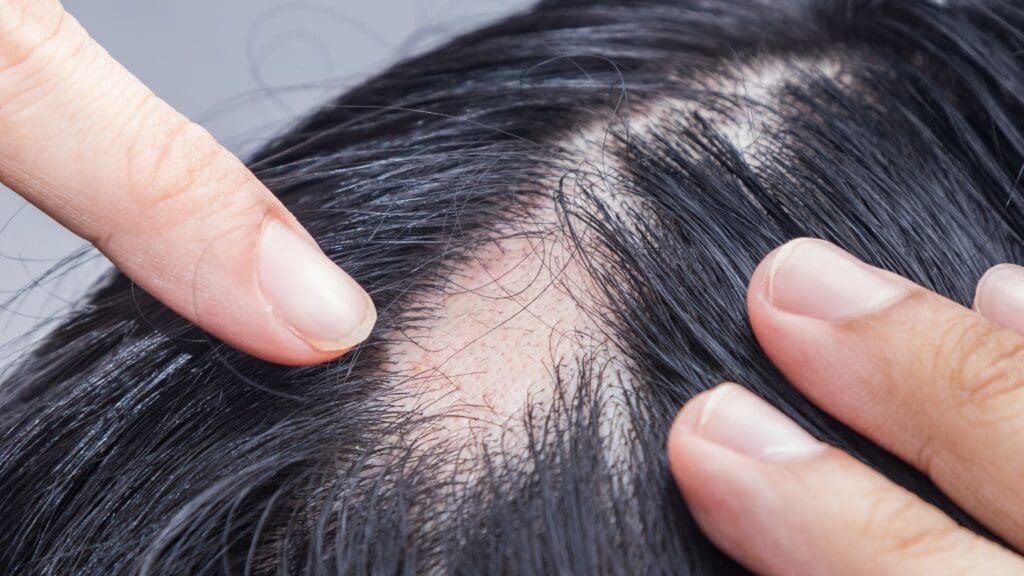 Injerto Capilar y Tratamientos de la Alopecia