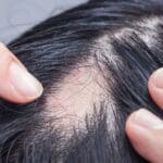 Injerto Capilar y Tratamientos de la Alopecia