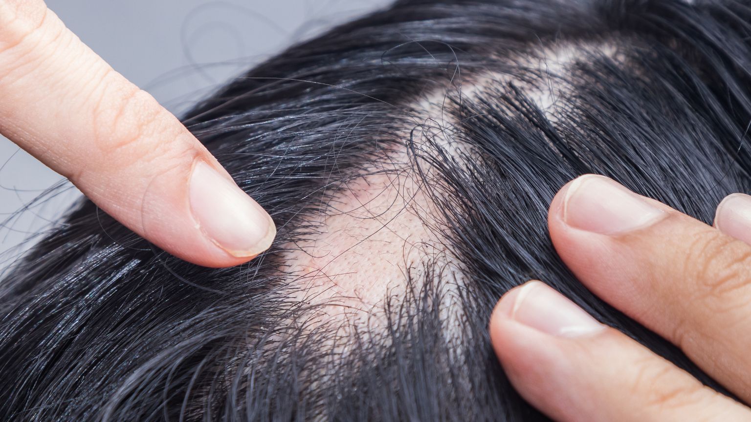 Tratamientos efectivos para la alopecia, injerto capilar y mesoterapia.