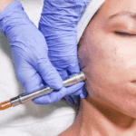 Microdermoabrasión para la piel