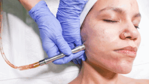 Microdermoabrasión para la piel