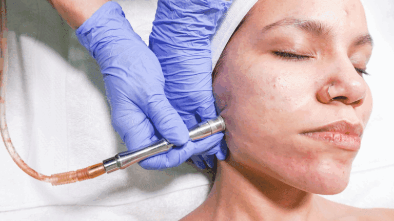 Microdermoabrasión para la piel