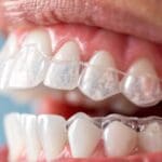 Paciente adulto mostrando sonrisa tras tratamiento con ortodoncia invisible en clínica dental especializada en estética dental