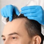 Hombre sometiéndose a un procedimiento de cirugía capilar en clínica especializada.