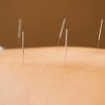 Acupuntura aplicada en la espalda durante un tratamiento de bienestar físico y emocional